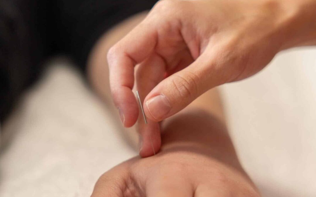 Acupuncture