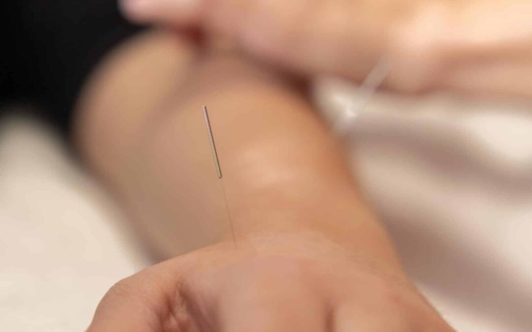 Acupuncture