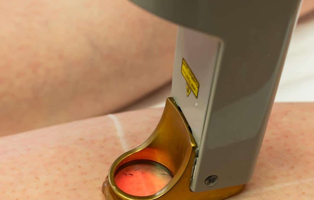 Épilation laser