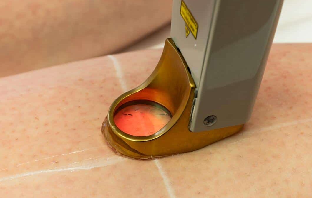 Épilation laser
